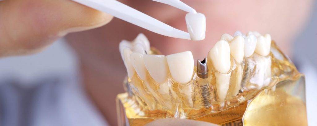 mouth-dental-implants