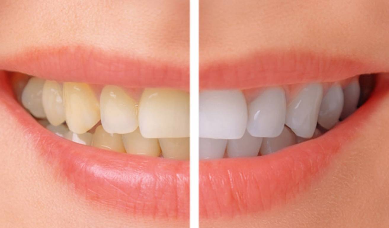 teeth-whitening