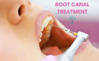 Root Canal Treatment in Best Dental Clinic in Indirapuram