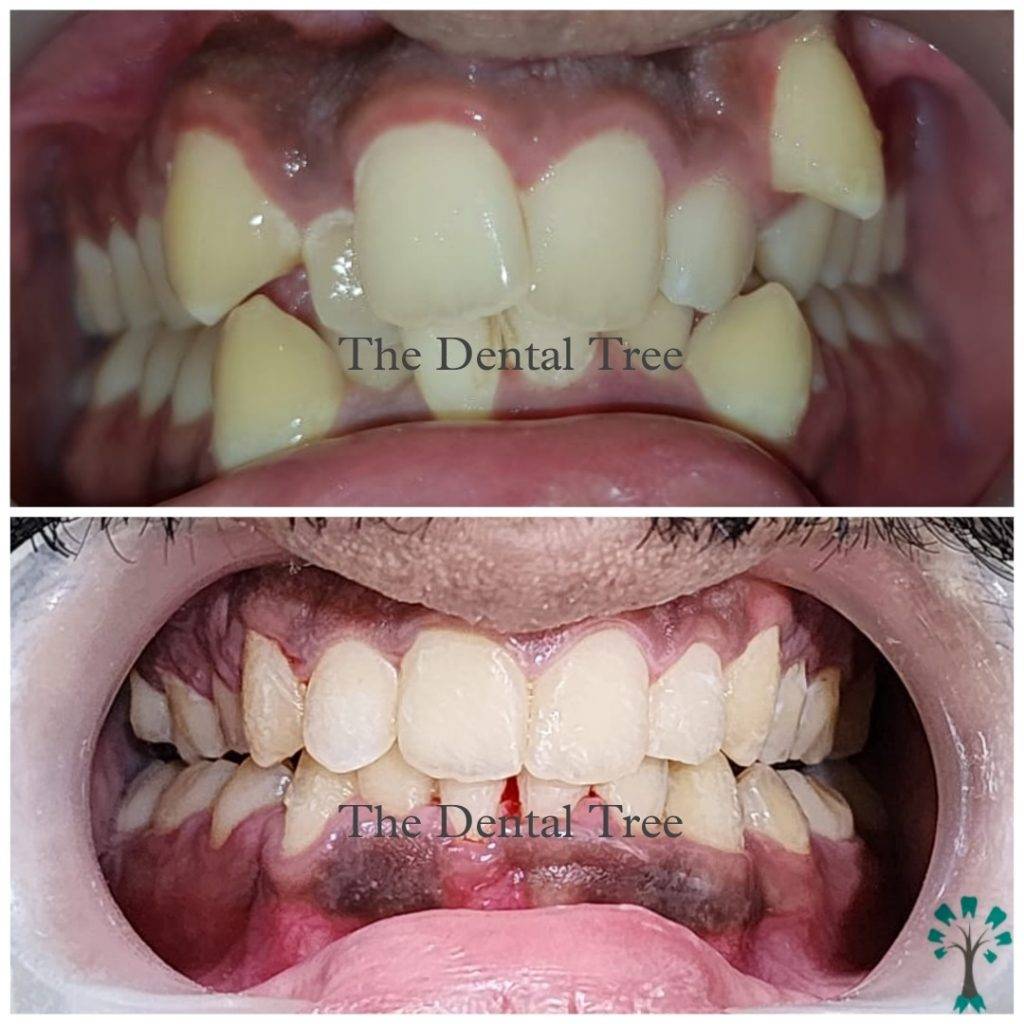 treatment-before-after (3)