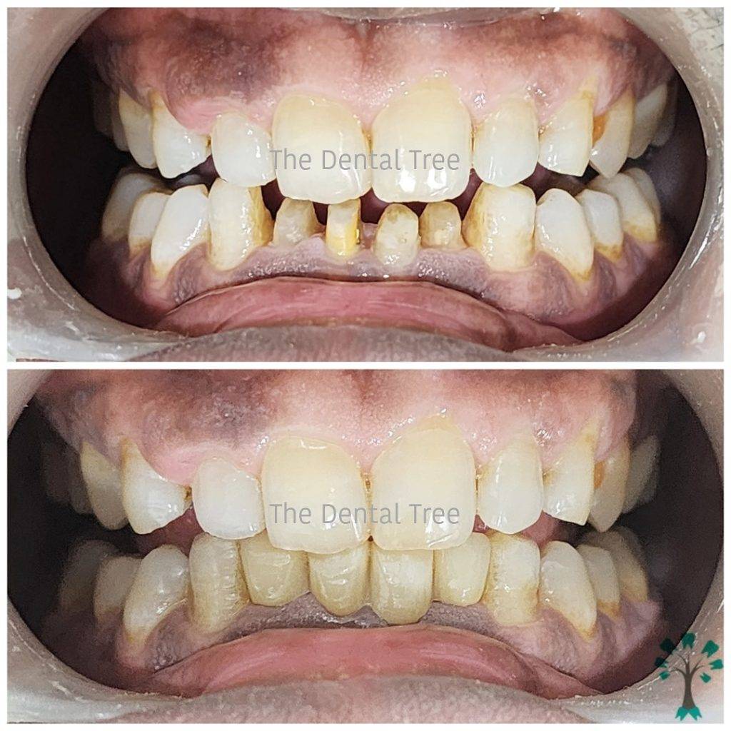 treatment-before-after (5)