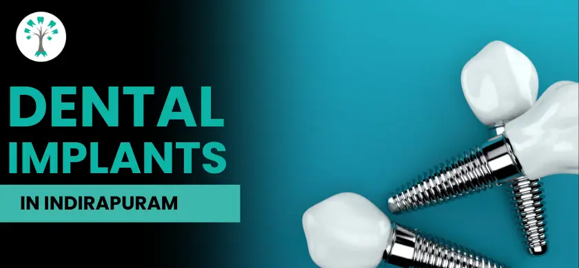 Best Dental Clinic in Indirapuram for Dental Implants