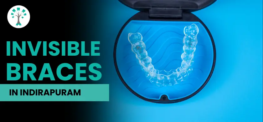 Best Dental Clinic in Indirapuram for Invisible Braces