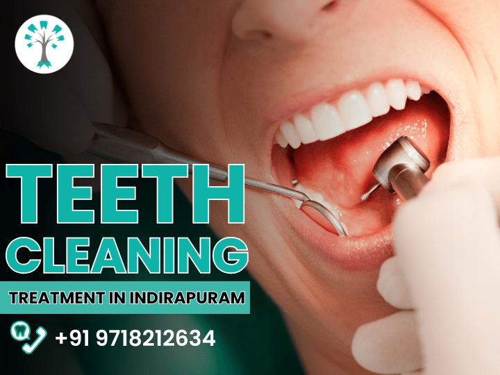 Teeth Cleaning Treatment in Indirapuram Teeth Cleaning Treatment in Indirapuram